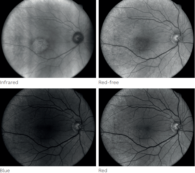 iCare DRSplus rozklad na jednotlivé spektra
