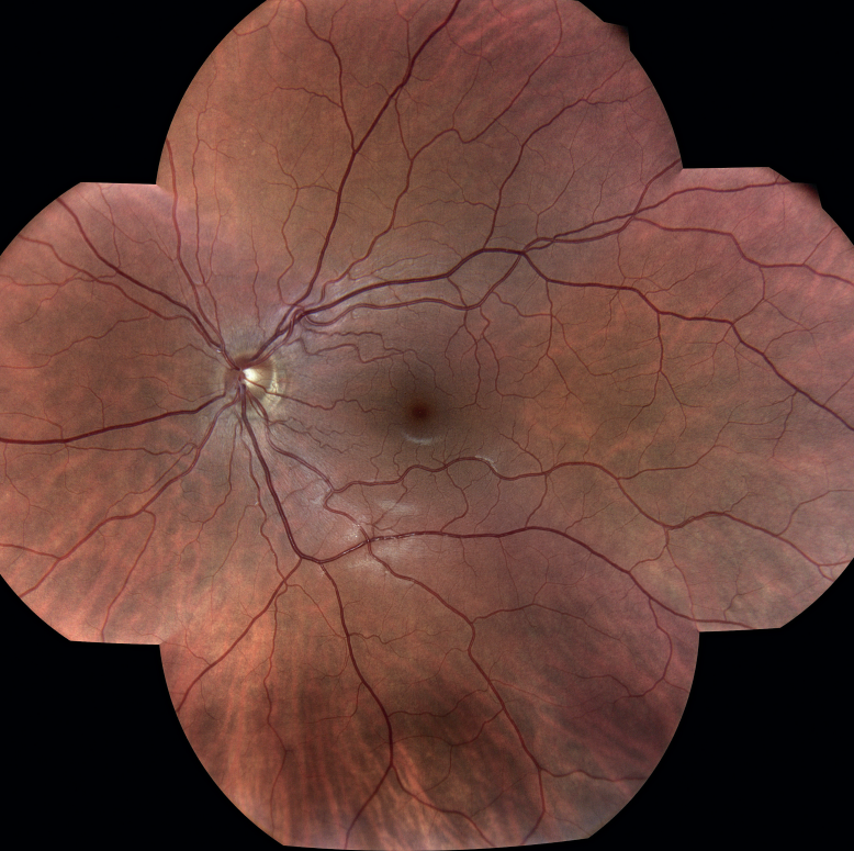 iCare DRSplus složený snímek