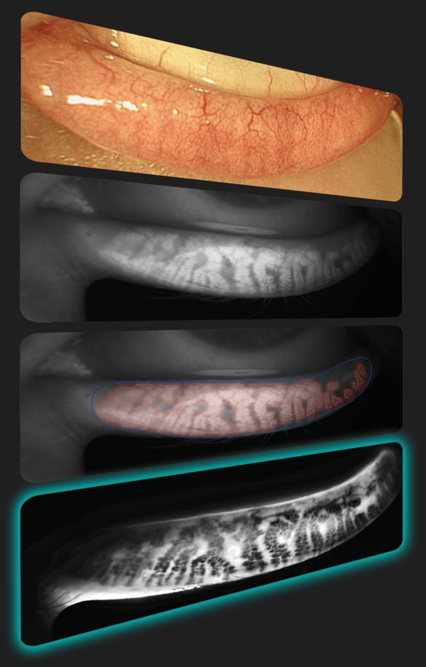 Quantel Medical C.DIAG Meibonské žlázy