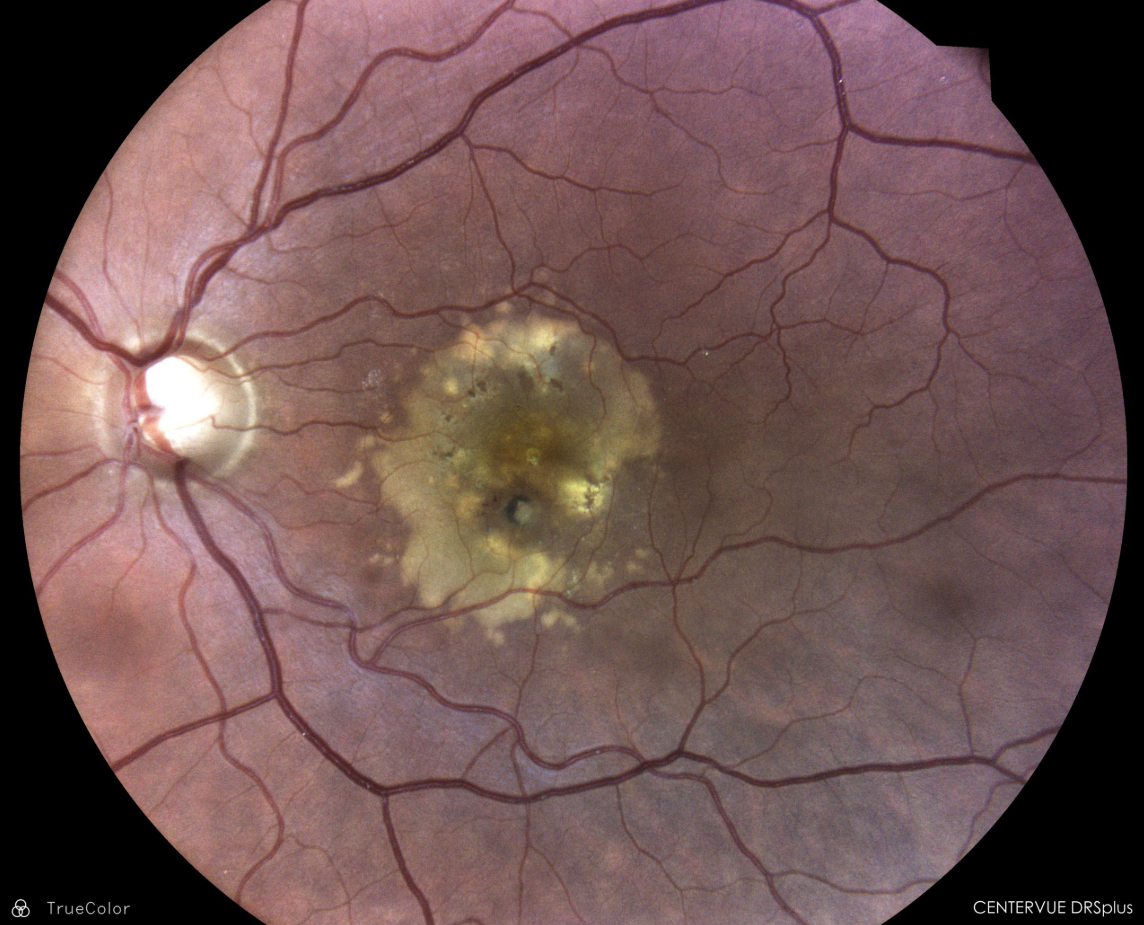 iCare DRSplus náhled snímku