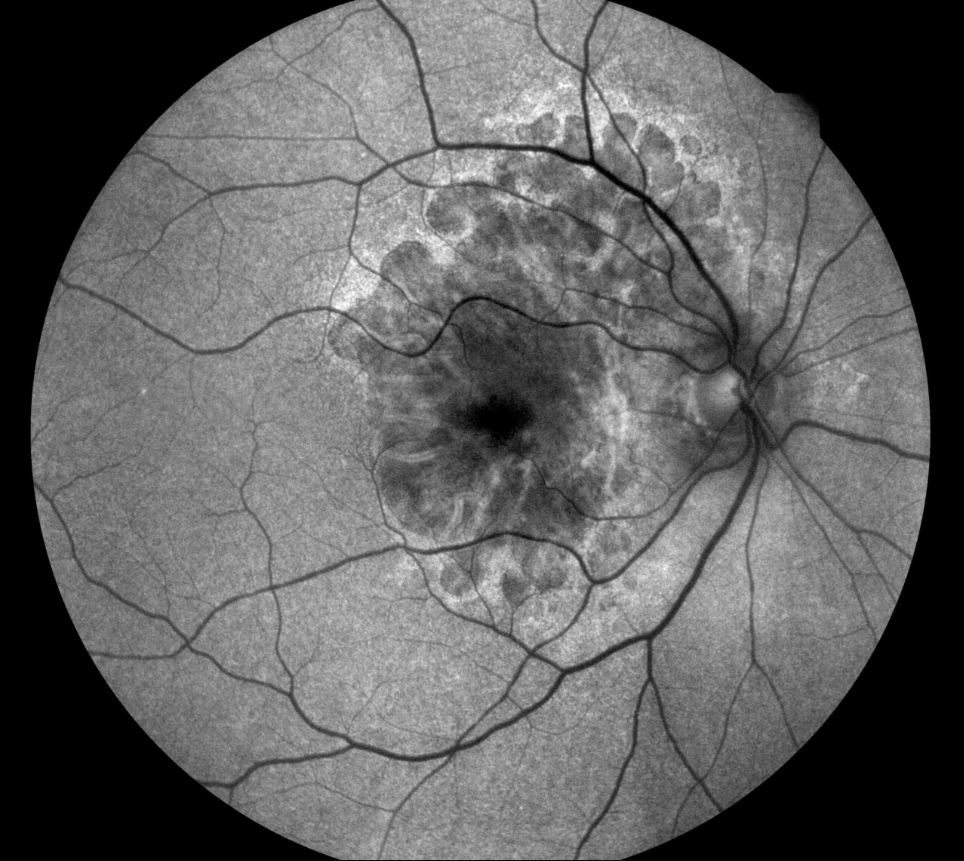 iCare EIDON AF snímek
