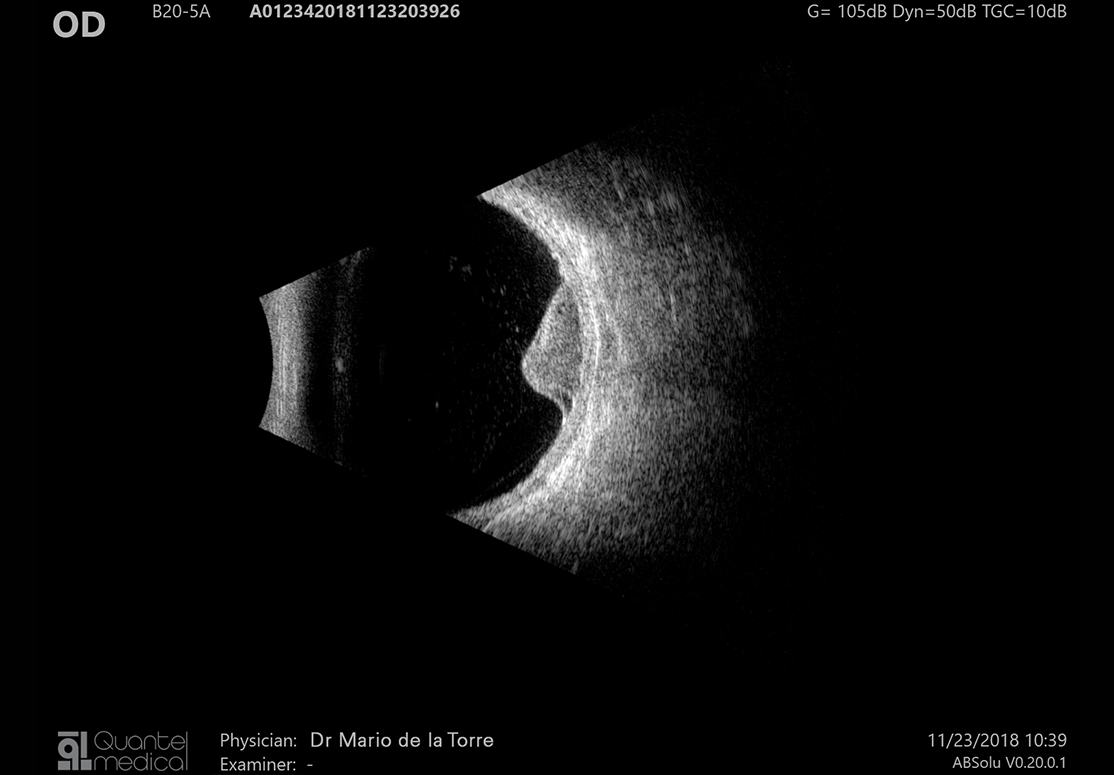 Vyšetření Standardizované A - Tumor