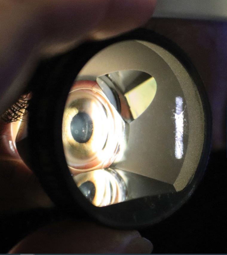 Vyšetřovací čočky VOLK ukázka použití